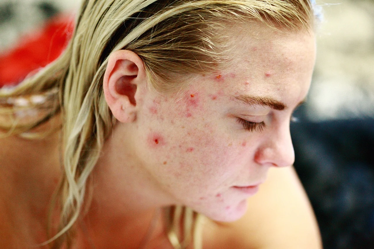 Young woman with red, inflamed pimples on her cheek and chin, a typical look of acne-prone skin