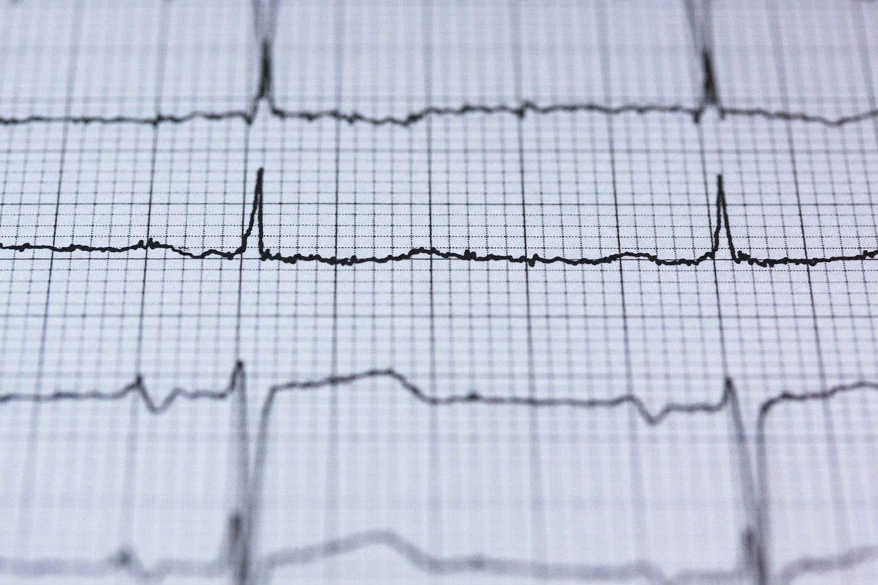 Close view of an ECG tracing on graph paper used to evaluate heart arrhythmia