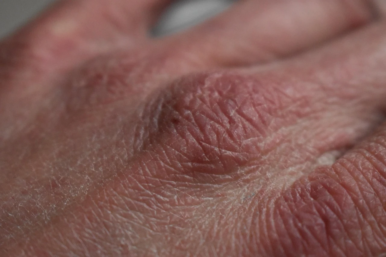 Close-up of dry, reddened, flaking skin on the back of a hand, typical of atopic eczema