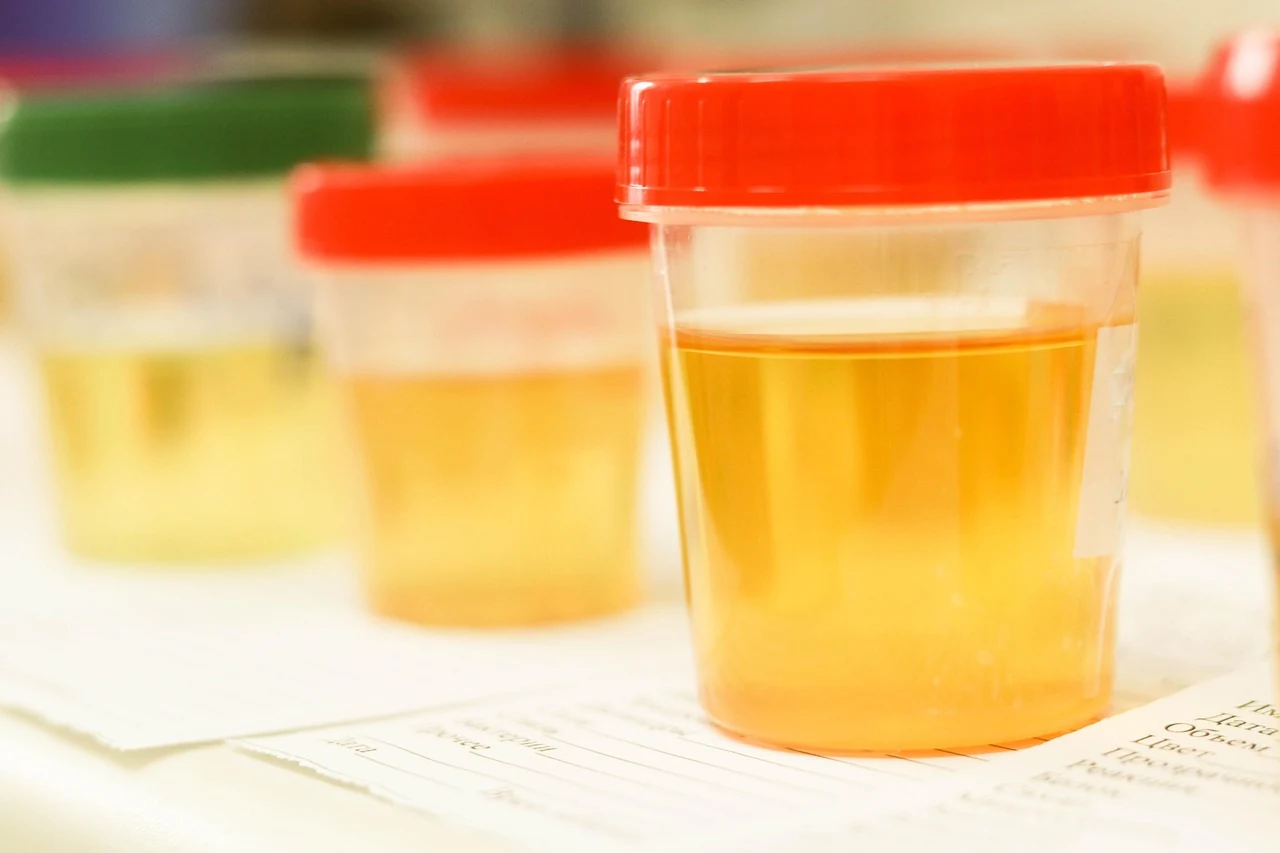 Plastic cups of urine samples lined up for lab testing, where doctors look for blood in urine and other changes