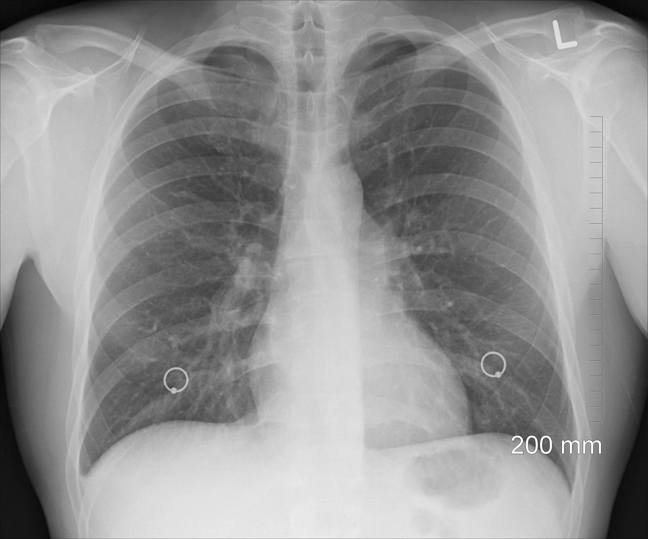 Chest X-ray showing both lungs and the heart, used to assess the lungs when lung cancer is suspected