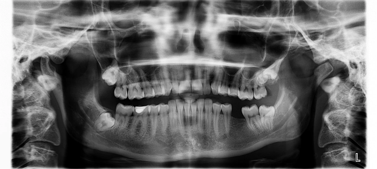 Panoramic dental X-ray of both jaws showing the position of the wisdom teeth and why they may need removal